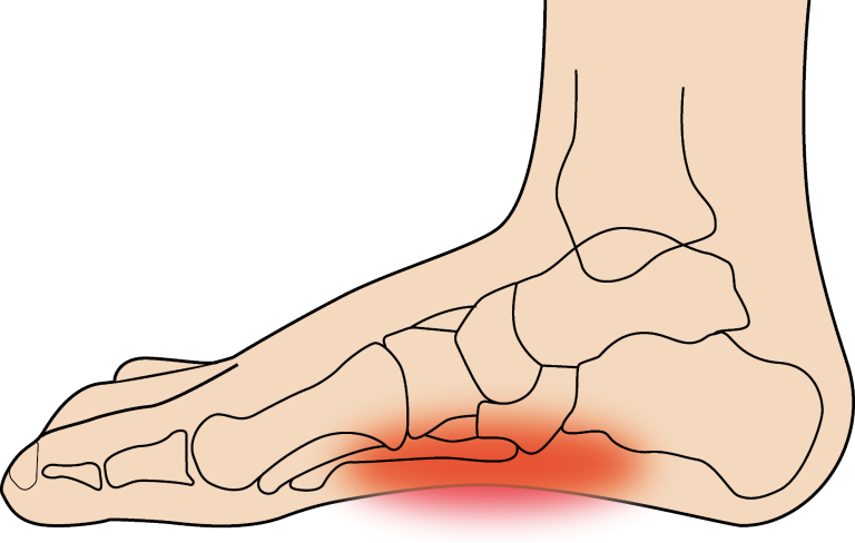 Plantarfasziitis Einlagen Würzburg Hickl Life