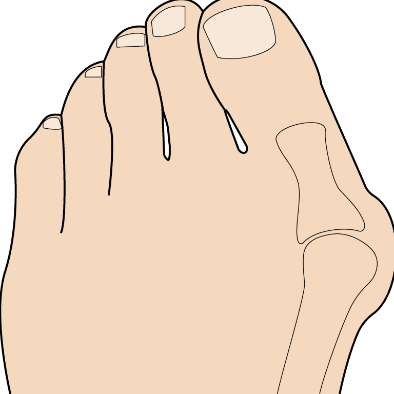 Hallux Valgus Einlagen Würzburg Hickl Life