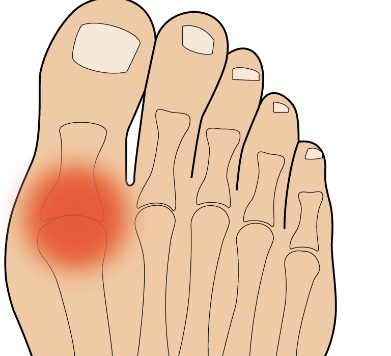 Hallux Rigidus Einlagen Würzburg Hickl Life